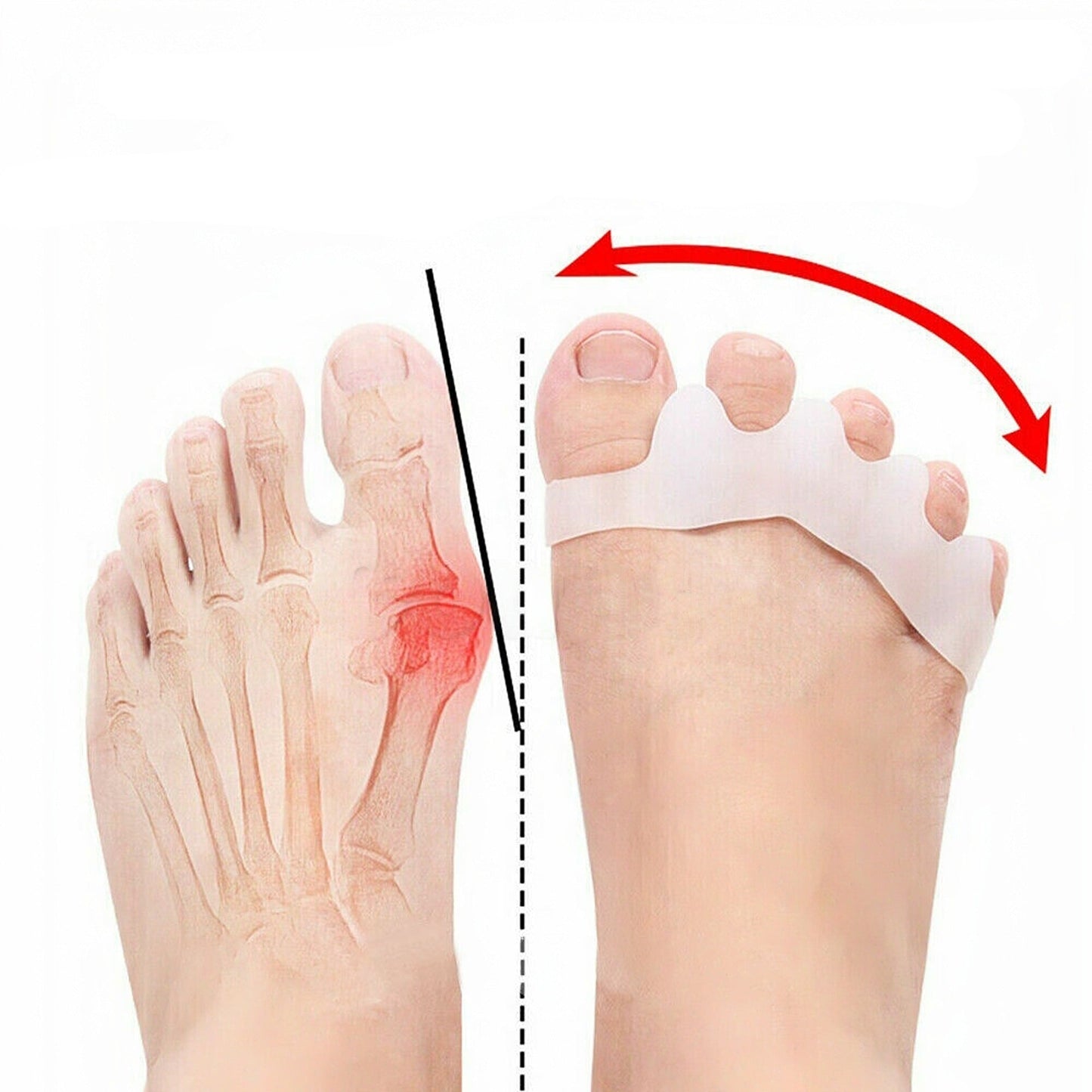 Gel Toe Separator for Bunions Silicone Corrector Hallux Straightener