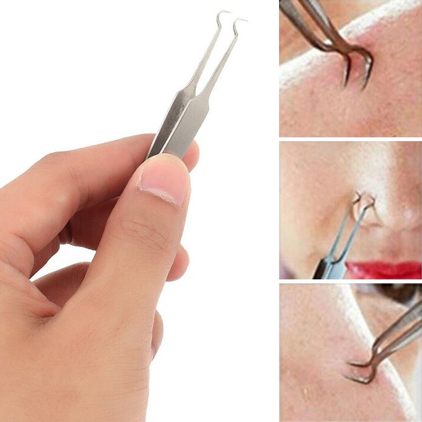 8-Piece Blackhead and Pimple Extractor Tool Set for Acne Treatment