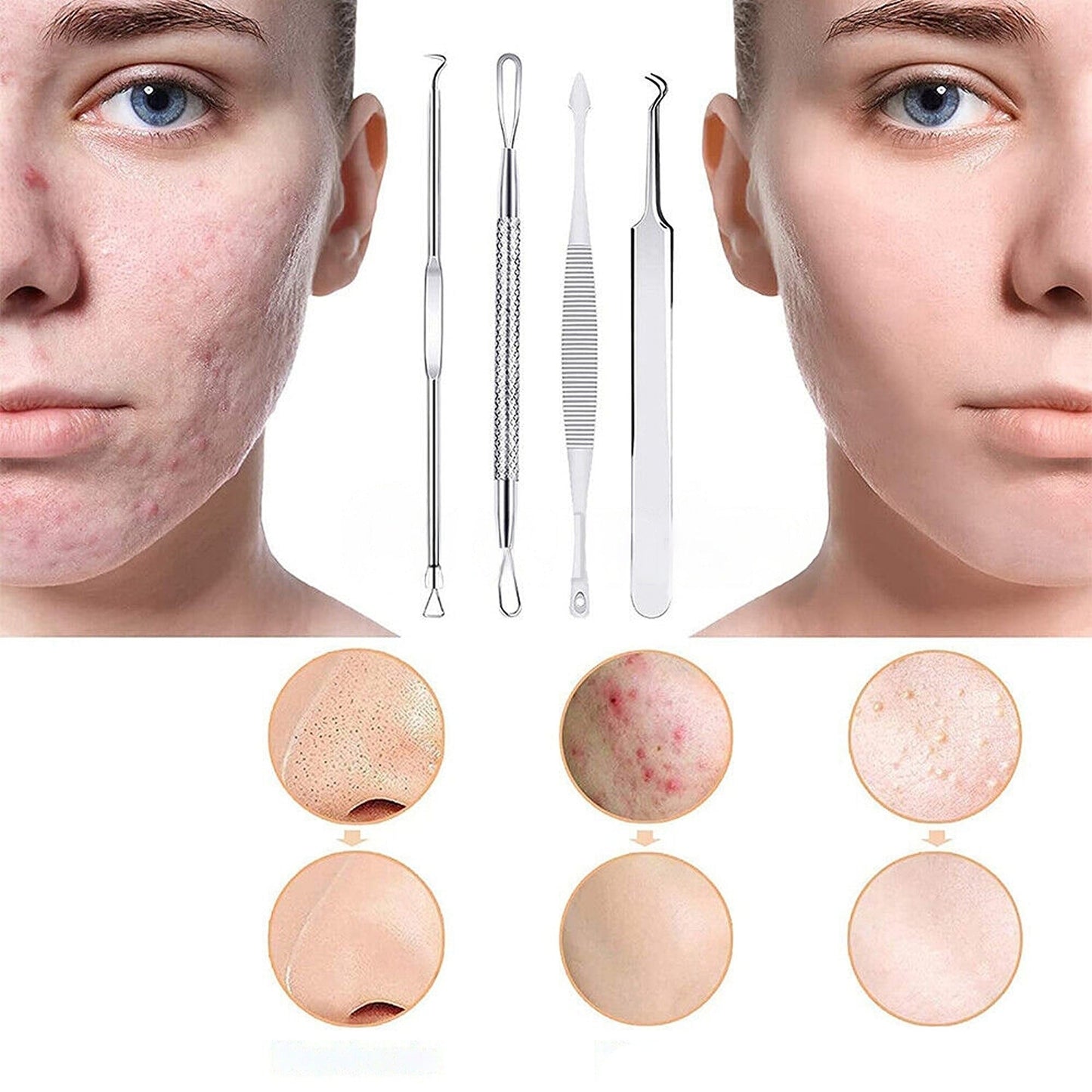 9pcs Comedone Extractor Tool Kit Blackhead Pimple Spot Remover