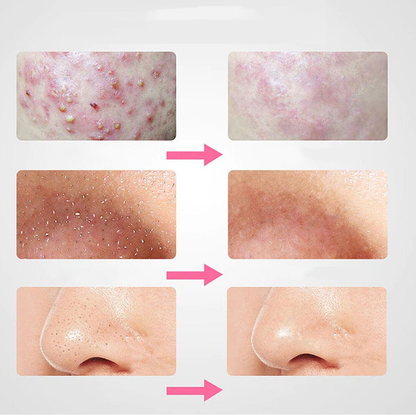 8-Piece Blackhead and Pimple Extractor Tool Set for Acne Treatment