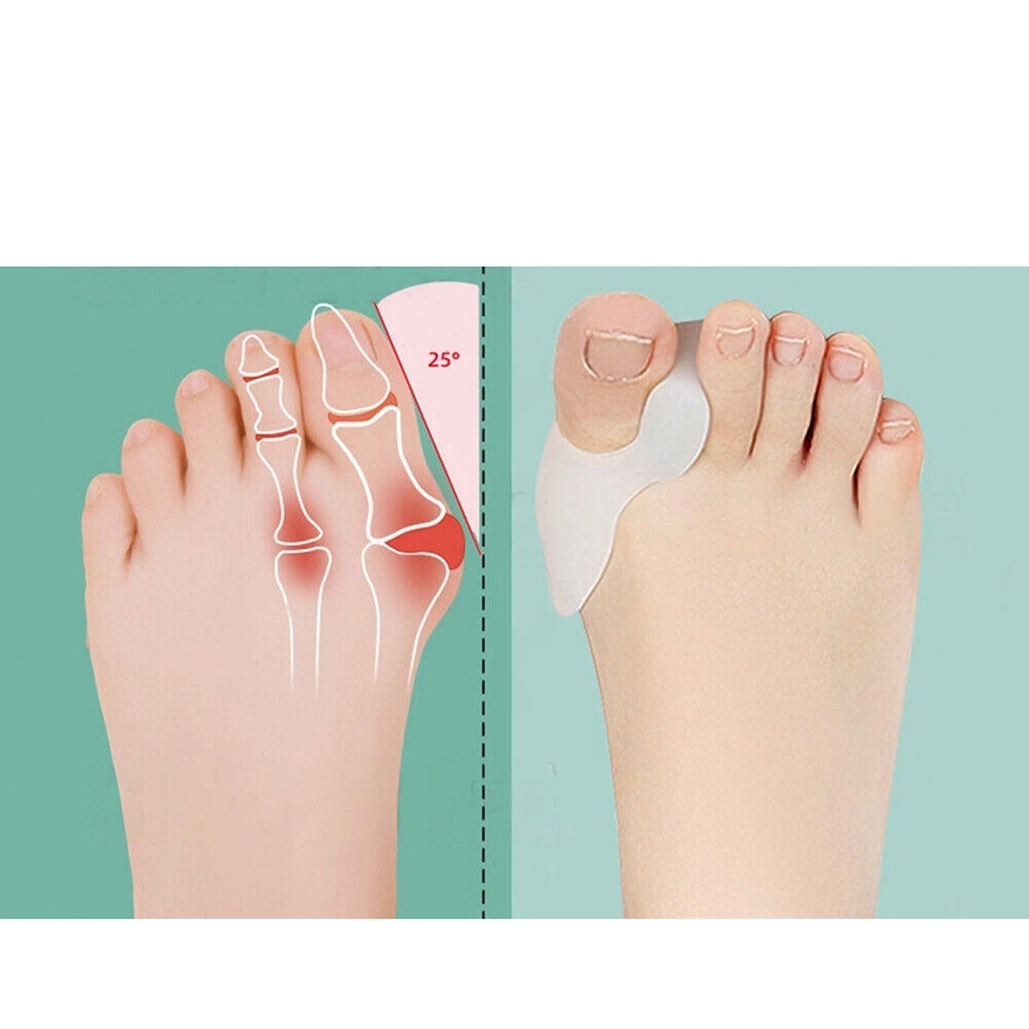 2pcs Hallux Valgus Bunion Corrector Silicone Gel Toe Separators