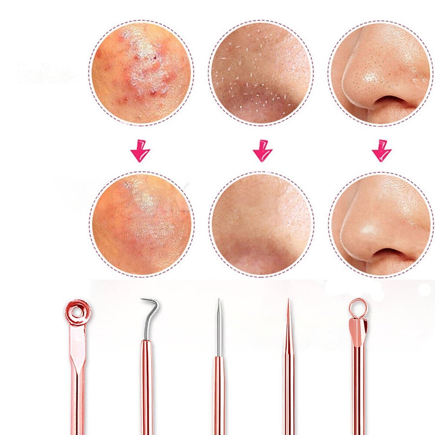 4pcs Blackhead Remover Tool Kit Pimple Popper Acne Blemish Comedone Cleaner